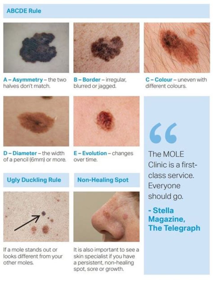 Do cancerous moles hurt?