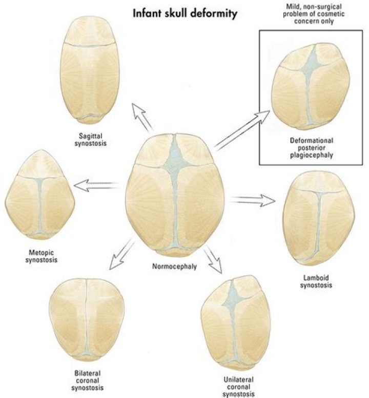 Does craniosynostosis surgery leave scars?