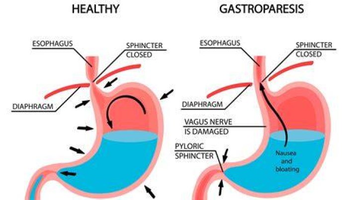 What are the symptoms of stomach paralysis?