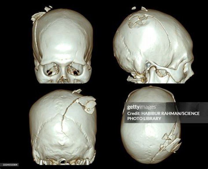 What is a hairline skull fracture?