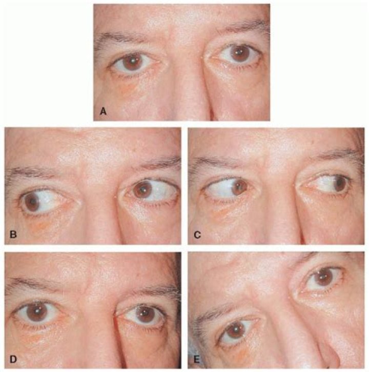 What is gaze misalignment?