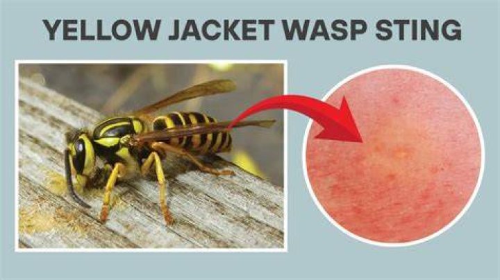Which sting is worse yellow jacket or wasp?